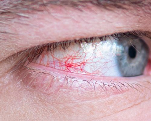 Diagnóstico y Control de Glaucoma